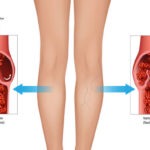 Top Signs of Chronic Venous Insufficiency in Adults